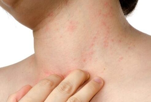 allergia con parassiti sottocutanei
