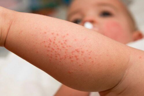 Allergia in un bambino come sintomo della presenza di vermi